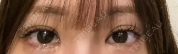 目尻切開 / タレ目形成・グラマラスライン（埋没） LOUIS CLINIC 二子玉川院【ルイクリニック】 DAY 7 メイン用