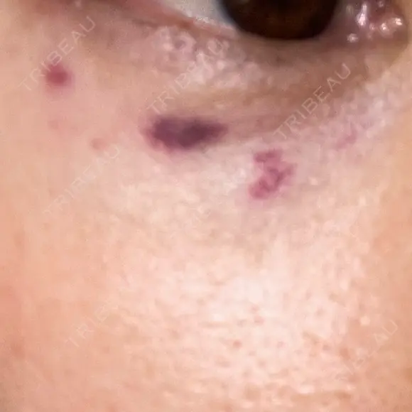 リジュラン 千葉美容外科アイビークリニック DAY 2 メイン用