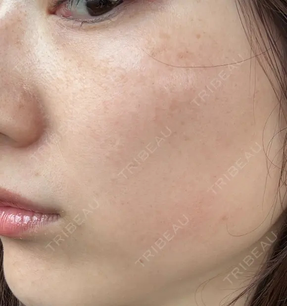 ピーリング（ハリ・ツヤ） / ルメッカ L‘amour clinic Tokyo【ラムールクリニック東京】 DAY 4 メイン用