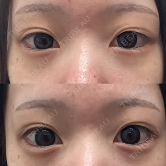 ヒアルロン酸注入（涙袋） AYANAフィラーズクリニック 渋谷院 AFTER メイン用