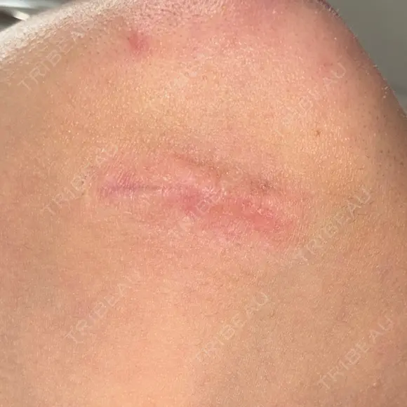 脂肪吸引（顔） / ネックリフト リラ・クラニオフェイシャル・クリニック DAY 86 メイン用