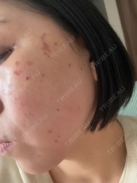 シミ取りレーザー / ピコレーザートーニング（美白・肝斑） 東京シルククリニック 東京神田院 DAY 0 メイン用