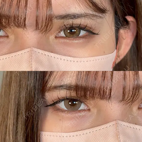 二重埋没 / 上まぶたの脂肪取り / 口角挙上 / ヒアルロン酸注入（涙袋） / ボトックス（エラ・小顔） / ヒアルロン酸注入（唇） / ボトックス（肩） アリエル美容クリニック 大宮院 AFTER メイン用