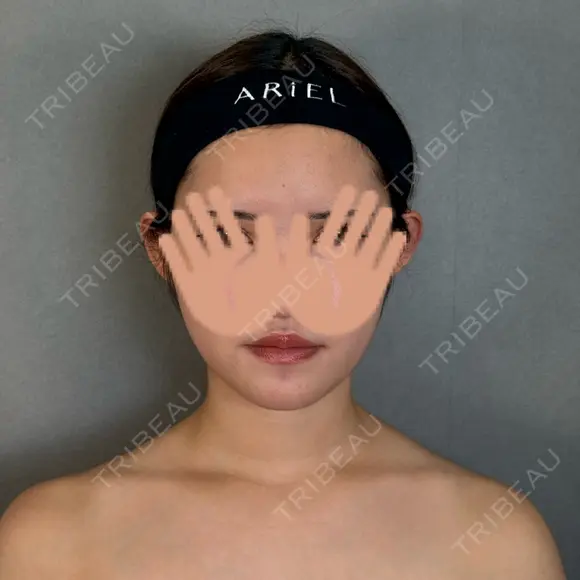 二重埋没 / 上まぶたの脂肪取り / 口角挙上 / ヒアルロン酸注入（涙袋） / ボトックス（エラ・小顔） / ヒアルロン酸注入（唇） / ボトックス（肩） アリエル美容クリニック 大宮院 DAY 111 メイン用