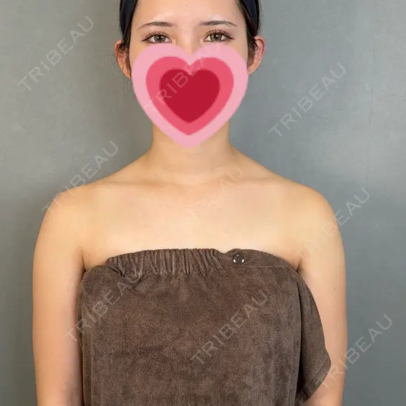 二重埋没 / 上まぶたの脂肪取り / 口角挙上 / ヒアルロン酸注入（涙袋） / ボトックス（エラ・小顔） / ヒアルロン酸注入（唇） / ボトックス（肩） アリエル美容クリニック 大宮院 DAY 111 メイン用