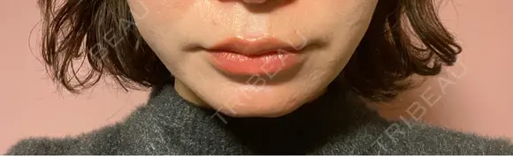 ボトックス（エラ・小顔） ルラ美容クリニック 郡山院 AFTER メイン用