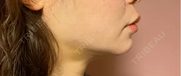 ボトックス（エラ・小顔） ルラ美容クリニック 郡山院 DAY 2 メイン用