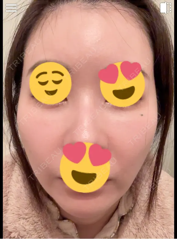 毛穴洗浄（ハイドラフェイシャルなど） / ピコレーザートーニング（美白・肝斑） 表参道ウィズ・クリニック DAY 4 メイン用