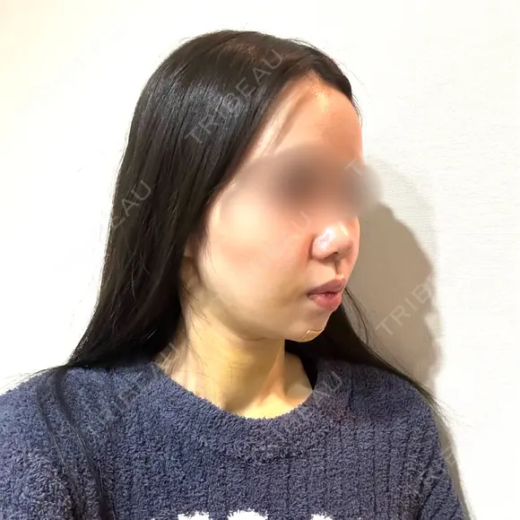 脂肪吸引（顔） / ジョールファット除去 / ボトックス（エラ・小顔） WOM CLINIC GINZA （ワム クリニック ギンザ） DAY 4 メイン用