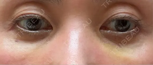 スネコス 札幌美容外科ネビュラクリニック DAY 3 メイン用