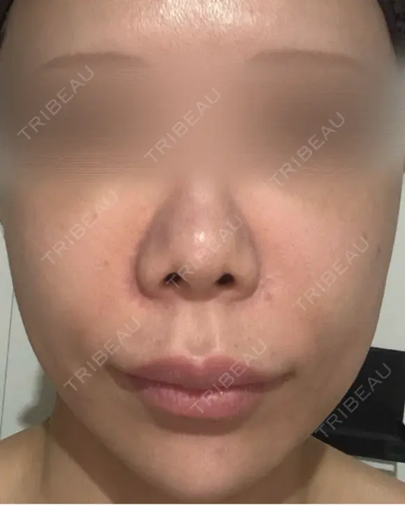 イオン導入 / 光治療（フォトフェイシャルなど） 城本クリニック 岡山院 AFTER メイン用