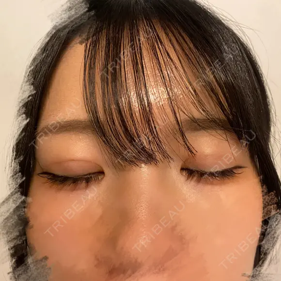 二重埋没 東京シンデレラ美容外科 池袋院 DAY 12 メイン用