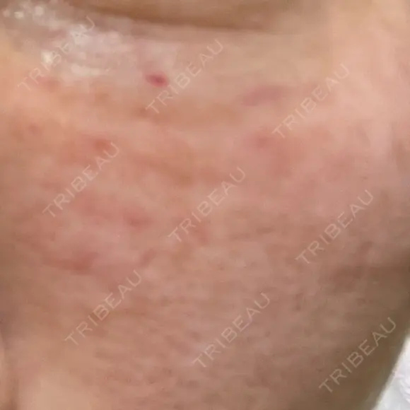 リジュラン ルヴィクリニック イオンドーム前院 DAY 1 メイン用