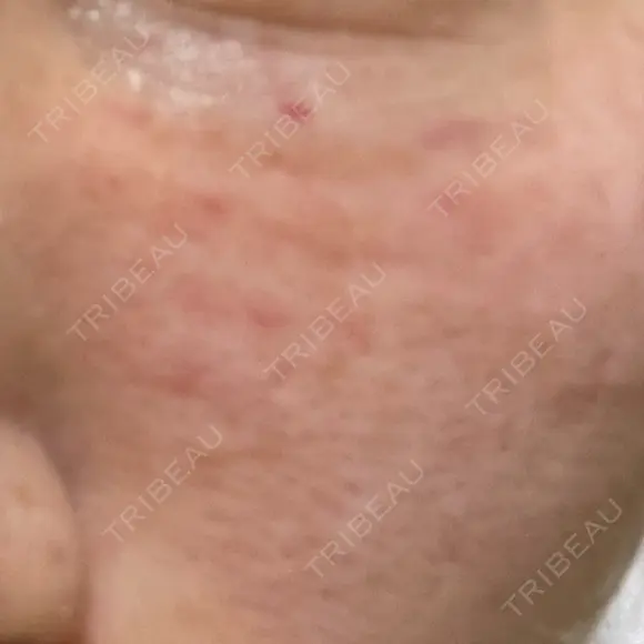 リジュラン ルヴィクリニック イオンドーム前院 DAY 1 メイン用