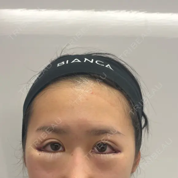目尻切開 / タレ目形成・グラマラスライン（切開） BIANCA銀座 DAY 0 メイン用