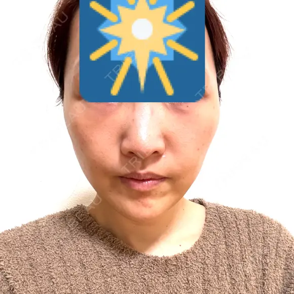 糸リフト / クマ治療 / 下まぶたたるみ取り / 脂肪注入（目の下） / ボトックス（あご） / その他（口元） アリエル美容クリニック 水戸院 DAY 21 メイン用