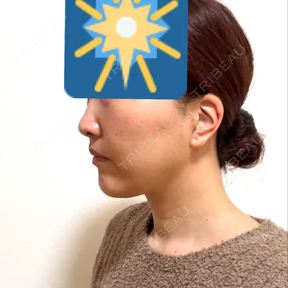 糸リフト / クマ治療 / 下まぶたたるみ取り / 脂肪注入（目の下） / ボトックス（あご） / その他（口元） アリエル美容クリニック 水戸院 DAY 21 メイン用