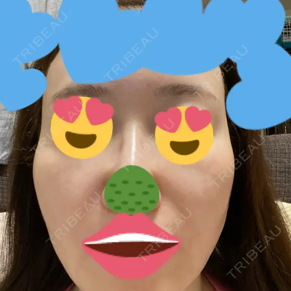 肌育注射（ジュベルックなど） / リジュラン 城本クリニック 大阪院 AFTER メイン用