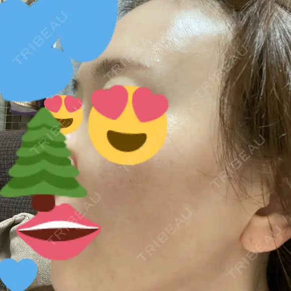 肌育注射（ジュベルックなど） / リジュラン 城本クリニック 大阪院 DAY 46 メイン用