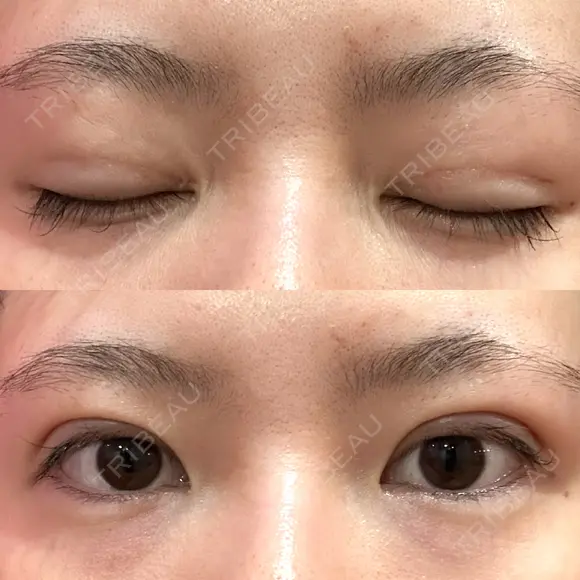 二重埋没 / 上まぶたの脂肪取り アリエル美容クリニック 郡山院 DAY 28 メイン用