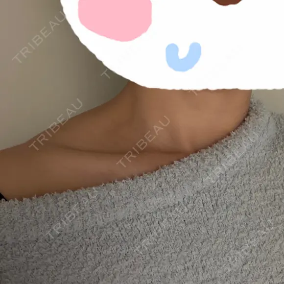 ボトックス（エラ・小顔） / ボトックス（肩） 新未来クリニック AFTER メイン用