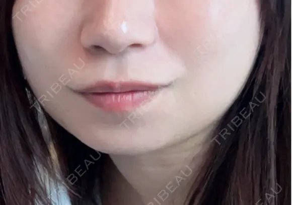 医療痩身（顔） / その他（肌） / RF（高周波）たるみ治療 / オンダリフト / その他（輪郭） ライブリークリニック 船橋院 AFTER メイン用