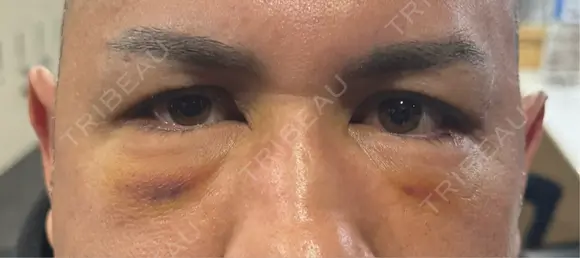 クマ治療 湘南美容クリニック 千葉センシティ院 DAY 3 メイン用