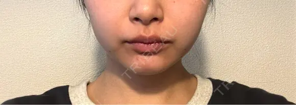 ハイフ（顔） / オンダリフト Ledian Clinic六本木 AFTER メイン用