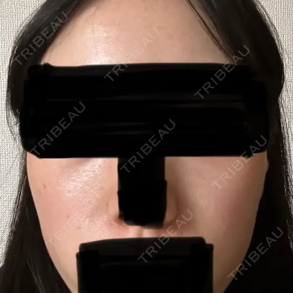 光治療（フォトフェイシャルなど） レナータクリニック 立川院 AFTER メイン用