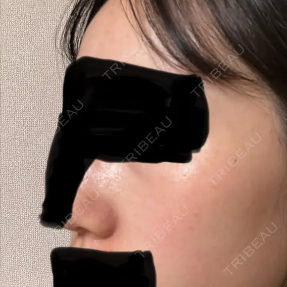 光治療（フォトフェイシャルなど） レナータクリニック 立川院 DAY 0 メイン用