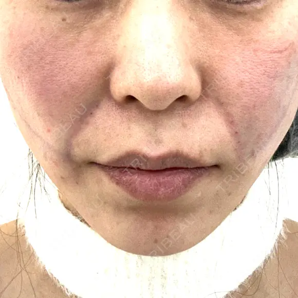 糸リフト / ボトックス（エラ・小顔） / ボトックス（額） / ボトックス（バニーライン） / ピコレーザートーニング（美白・肝斑） / ショッピングリフト APスキンクリニック銀座 DAY 0 メイン用