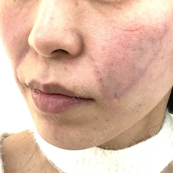 糸リフト / ボトックス（エラ・小顔） / ボトックス（額） / ボトックス（バニーライン） / ピコレーザートーニング（美白・肝斑） / ショッピングリフト APスキンクリニック銀座 DAY 0 メイン用