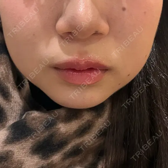 オンダリフト ルラ美容クリニック 渋谷本院 AFTER メイン用