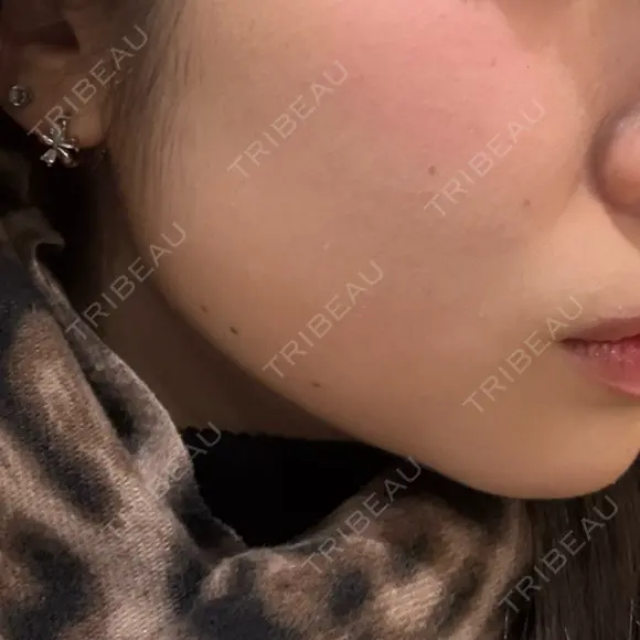 オンダリフト ルラ美容クリニック 渋谷本院 DAY 4 メイン用