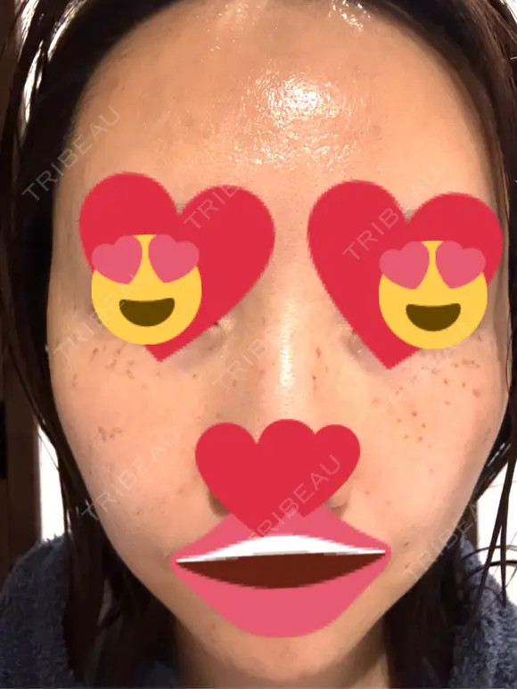 ピコスポット Fellez Clinic【フェルズクリニック】 DAY 4 メイン用