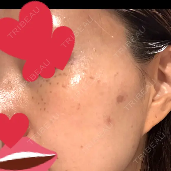 ピコスポット Fellez Clinic【フェルズクリニック】 DAY 4 メイン用