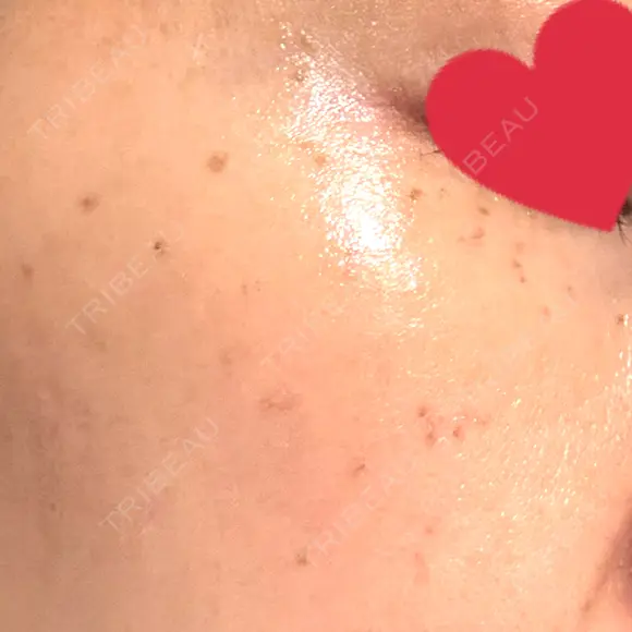 ピコスポット Fellez Clinic【フェルズクリニック】 DAY 4 メイン用