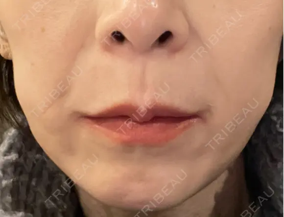 ハイフ（顔） 共立美容外科 大阪本院 DAY 10 メイン用