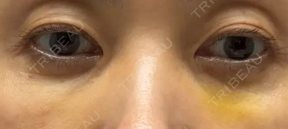 スネコス 札幌美容外科ネビュラクリニック DAY 6 メイン用