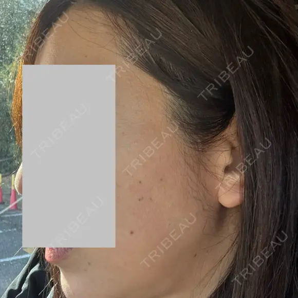 RF（高周波）たるみ治療 / インモード plume clinic DAY 0 メイン用