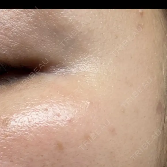 ほくろ・いぼ除去レーザー（肌） Fellez Clinic【フェルズクリニック】 AFTER メイン用