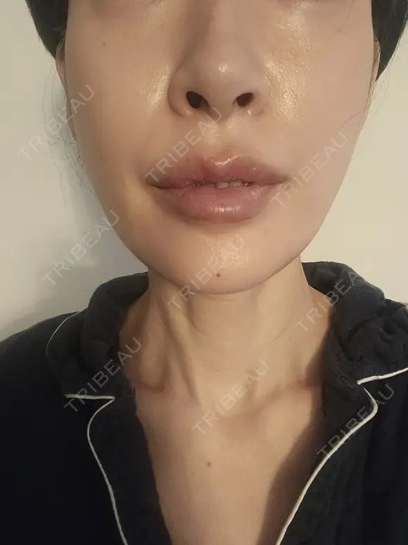 糸リフト 形成外科と美容外科のクリニック池袋 AFTER メイン用