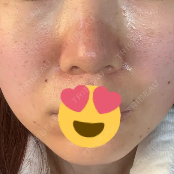 ニードルRF（ポテンツァなど） レナータクリニック 立川院 DAY 0 メイン用