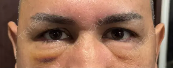 クマ治療 湘南美容クリニック 千葉センシティ院 DAY 4 メイン用