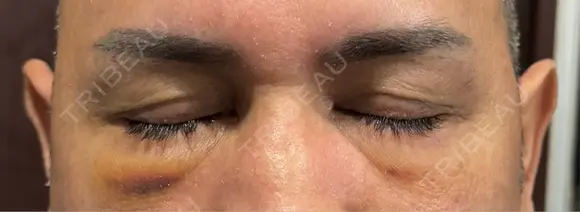 クマ治療 湘南美容クリニック 千葉センシティ院 DAY 4 メイン用