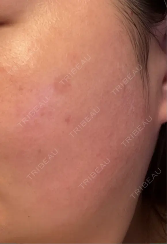 その他（肌） / シミ取りレーザー / ルメッカ ルラ美容クリニック 郡山院 AFTER メイン用