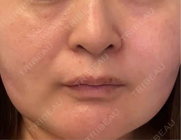 その他（肌） / シミ取りレーザー / ルメッカ ルラ美容クリニック 郡山院 DAY 56 メイン用