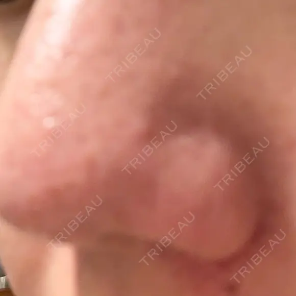 アグネス 日本美容・医療クリニック 六本木院 DAY 4 メイン用