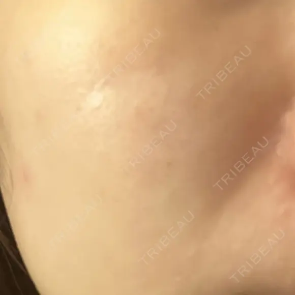 医療脱毛（顔） S-Laboクリニック 渋谷院 DAY 0 メイン用