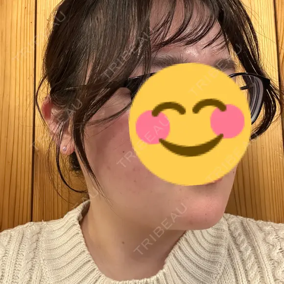 ボトックス（エラ・小顔） フィラークリニック 大阪心斎橋院 DAY 24 メイン用